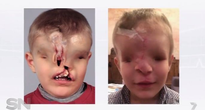 أستراليا: الطفل المغربي الذي ولد من دون ملامح يحصل على وجه جديد [صور]  